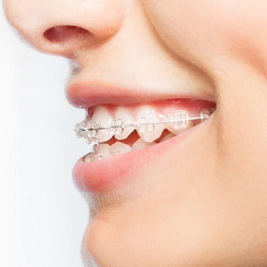 Műtéti fogszabályozás
